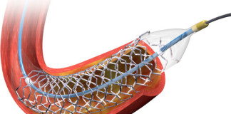 Coronary stents to be included in NLEM soon