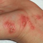 scrub-typhus-nepalaaja