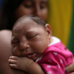 Baby with Zika induced Microencephaly