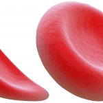 Sickle-Cell-Dis