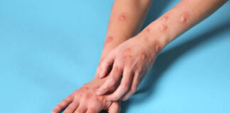Mpox virus of West African Clade 2 confirmed in isolated patient in India
